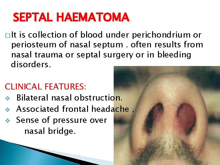 SEPTAL HAEMATOMA � It is collection of blood under perichondrium or periosteum of nasal