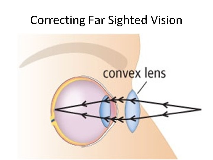 Correcting Far Sighted Vision 