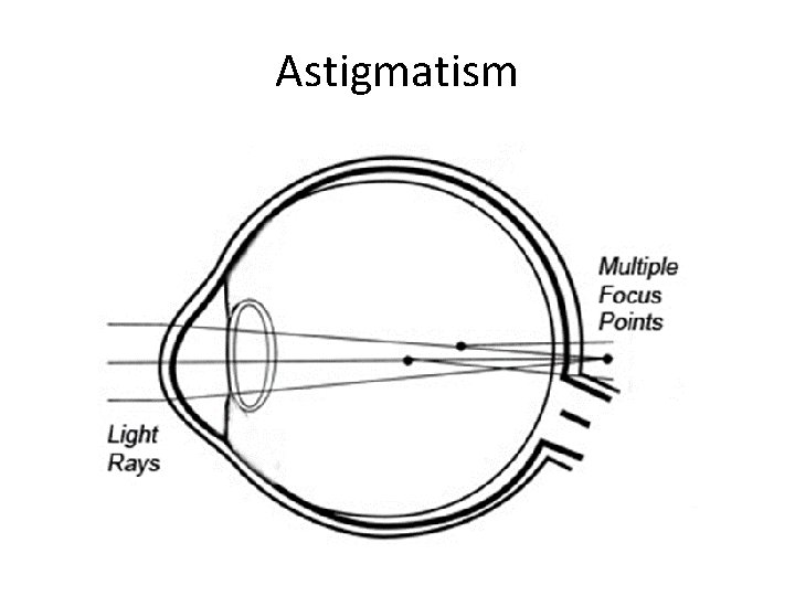 Astigmatism 