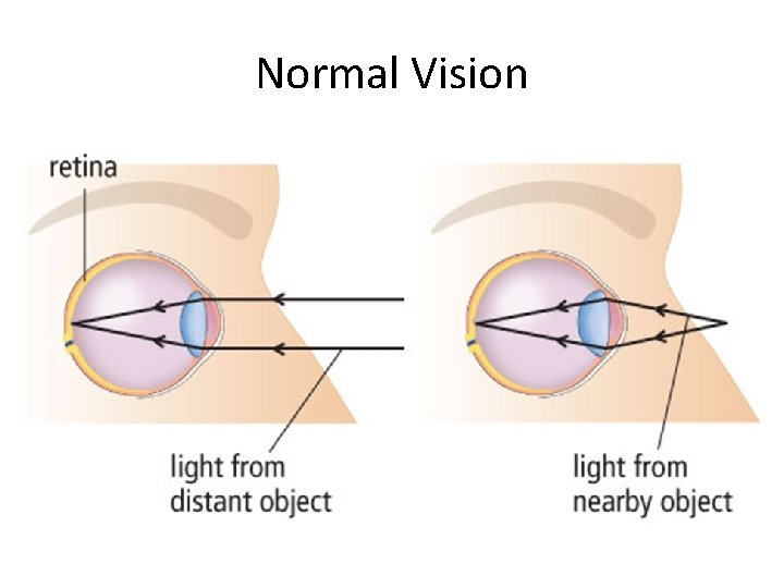 Normal Vision 