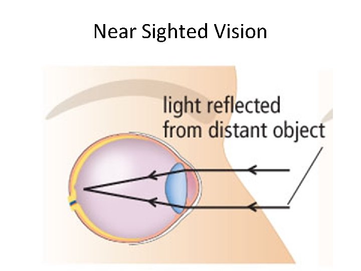 Near Sighted Vision 