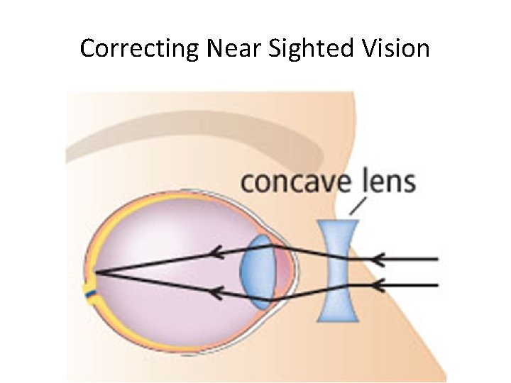 Correcting Near Sighted Vision 