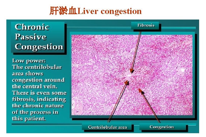 肝淤血Liver congestion 