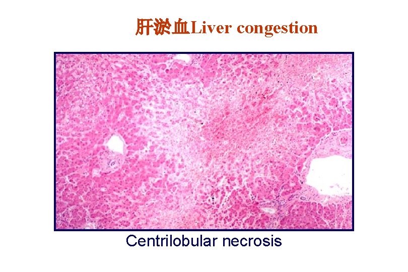 肝淤血Liver congestion Centrilobular necrosis 