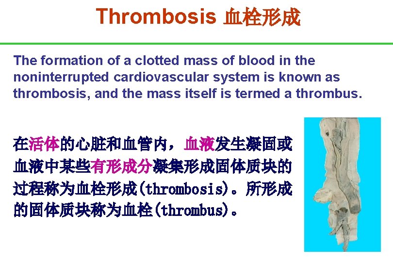 Thrombosis 血栓形成 The formation of a clotted mass of blood in the noninterrupted cardiovascular