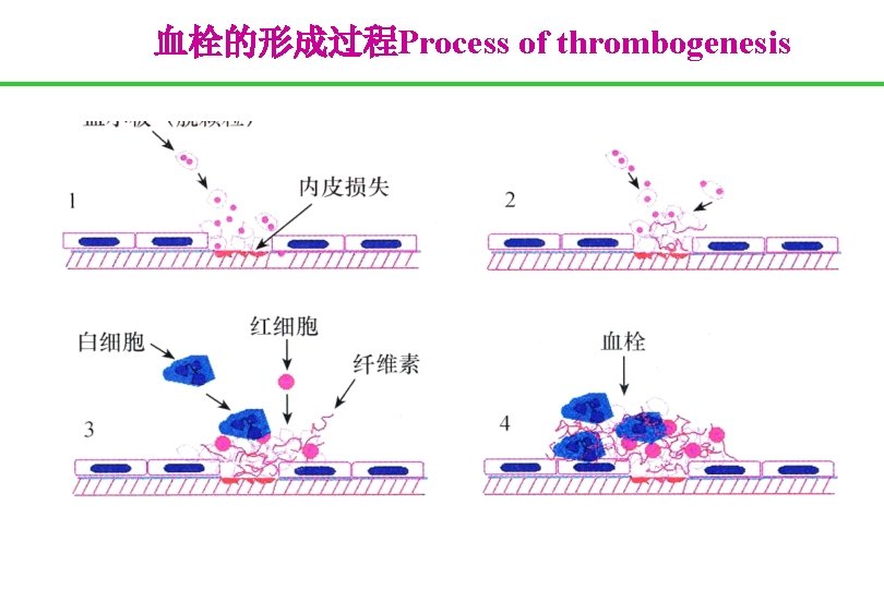 血栓的形成过程Process of thrombogenesis 