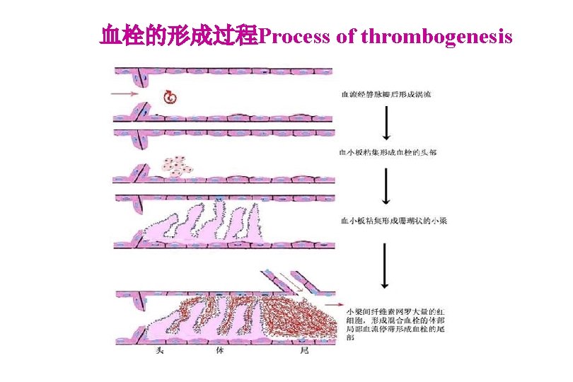 血栓的形成过程Process of thrombogenesis 