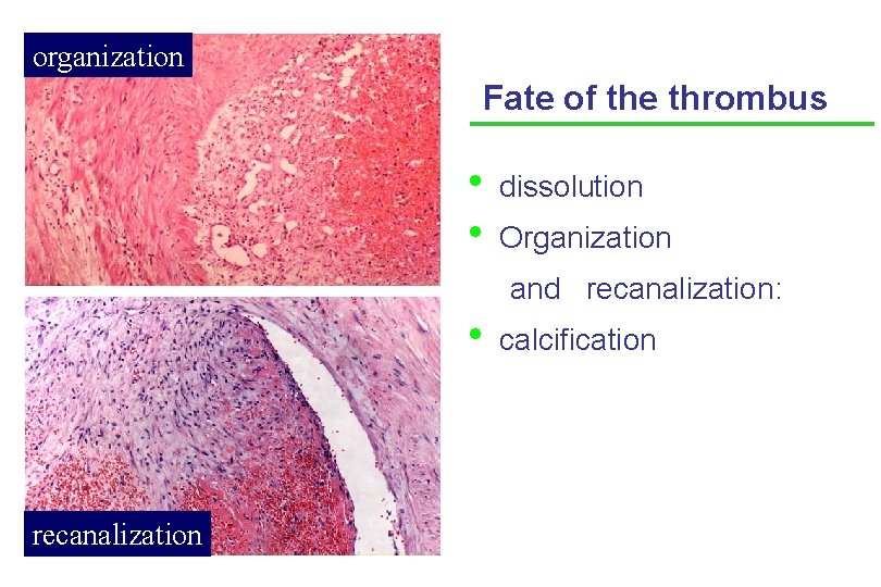 organization Fate of the thrombus • • dissolution Organization and recanalization: • recanalization calcification