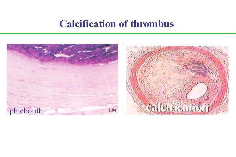 Calcification of thrombus phlebolith 