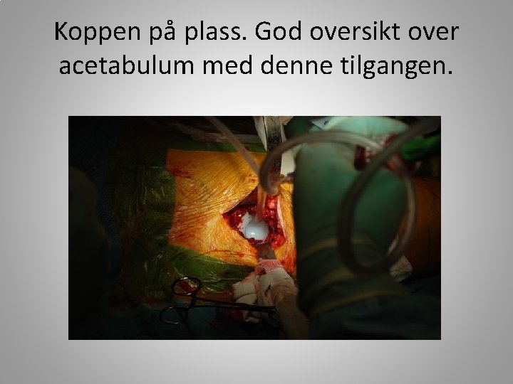 Koppen på plass. God oversikt over acetabulum med denne tilgangen. 