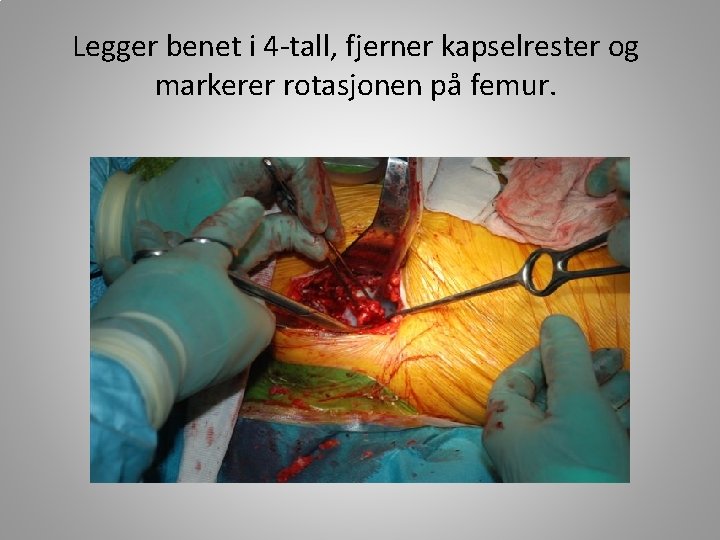 Legger benet i 4 -tall, fjerner kapselrester og markerer rotasjonen på femur. 