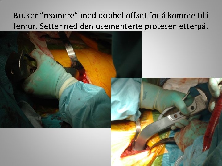 Bruker ”reamere” med dobbel offset for å komme til i femur. Setter ned den