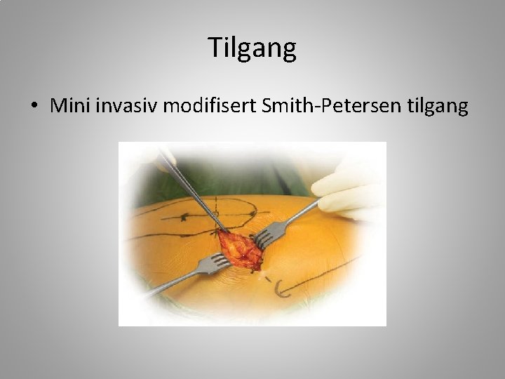 Tilgang • Mini invasiv modifisert Smith-Petersen tilgang 