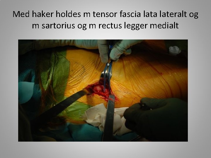 Med haker holdes m tensor fascia lateralt og m sartorius og m rectus legger