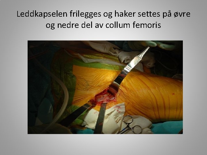 Leddkapselen frilegges og haker settes på øvre og nedre del av collum femoris 