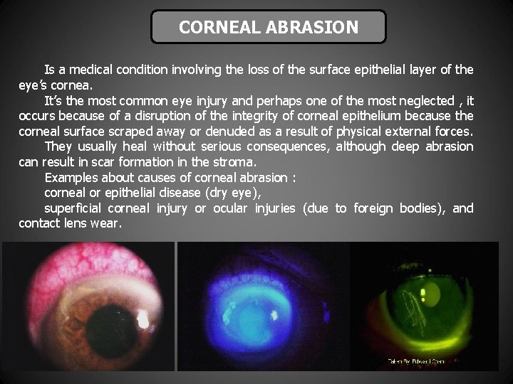 CORNEAL ABRASION Is a medical condition involving the loss of the surface epithelial layer