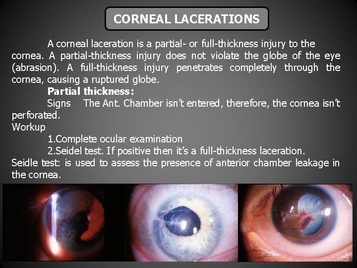 CORNEAL LACERATIONS A corneal laceration is a partial- or full-thickness injury to the cornea.