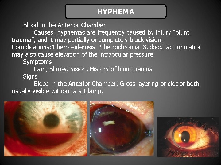 LIDHYPHEMA LACERATIONS Blood in the Anterior Chamber Causes: hyphemas are frequently caused by injury