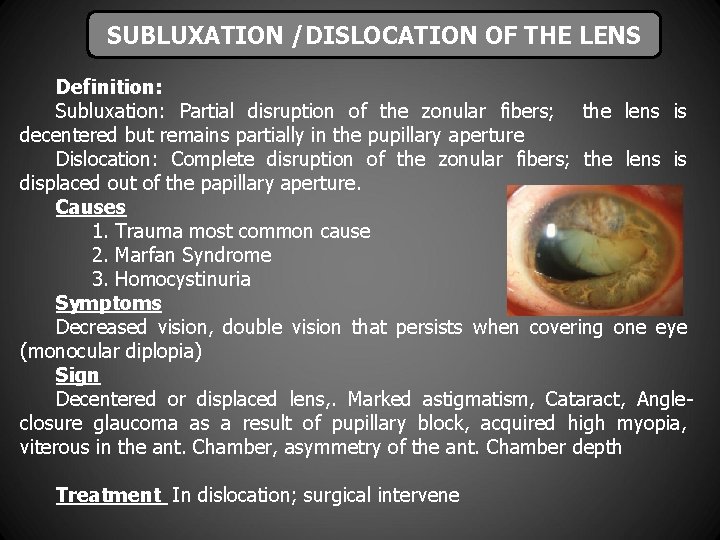 SUBLUXATION /DISLOCATION OF THE LENS Definition: Subluxation: Partial disruption of the zonular fibers; the