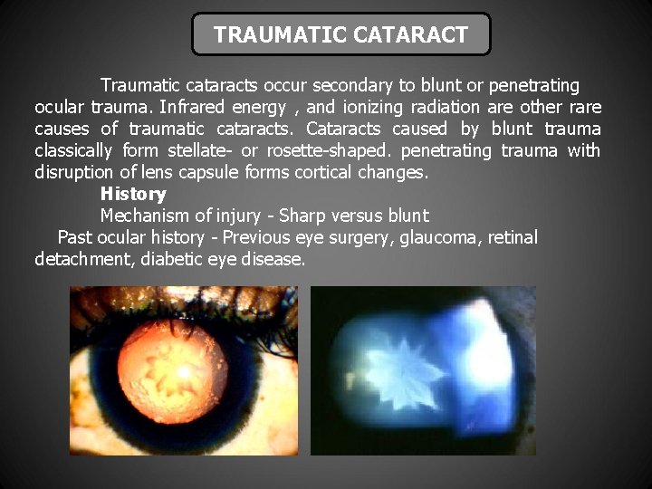 TRAUMATIC CATARACT Traumatic cataracts occur secondary to blunt or penetrating ocular trauma. Infrared energy