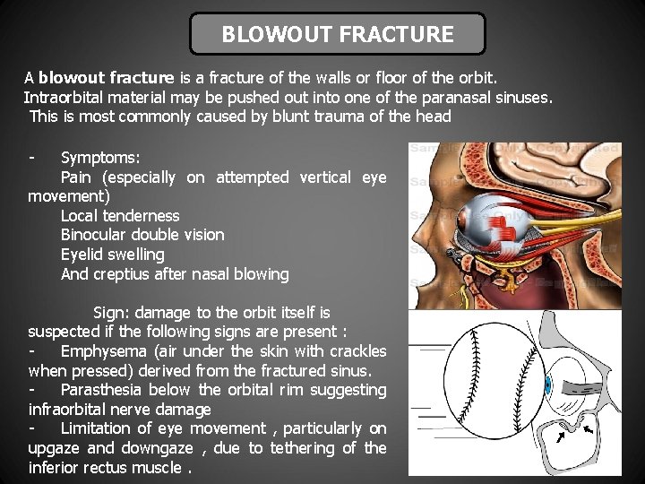 BLOWOUT FRACTURE A blowout fracture is a fracture of the walls or floor of