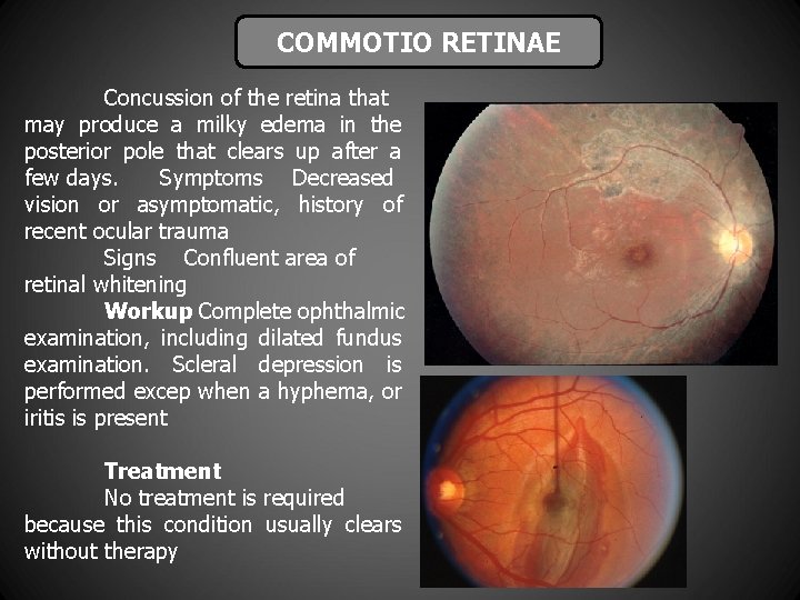 COMMOTIO RETINAE Concussion of the retina that may produce a milky edema in the