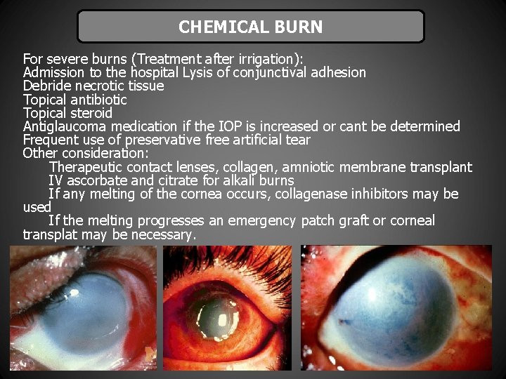 CHEMICAL BURN For severe burns (Treatment after irrigation): Admission to the hospital Lysis of