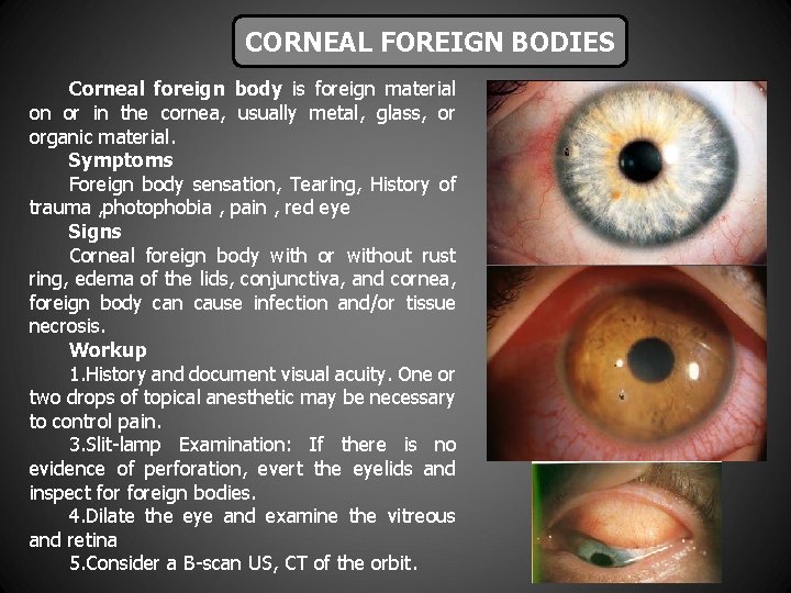 CORNEAL FOREIGN BODIES Corneal foreign body is foreign material on or in the cornea,