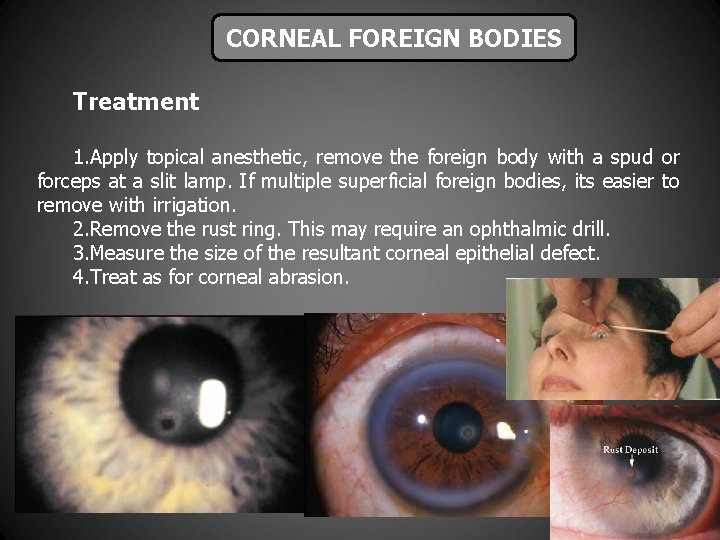 CORNEAL FOREIGN BODIES Treatment 1. Apply topical anesthetic, remove the foreign body with a