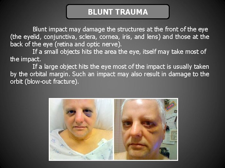 BLUNT TRAUMA Blunt impact may damage the structures at the front of the eye