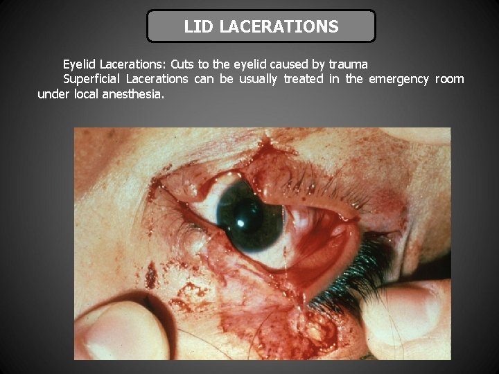 LID LACERATIONS Eyelid Lacerations: Cuts to the eyelid caused by trauma Superficial Lacerations can