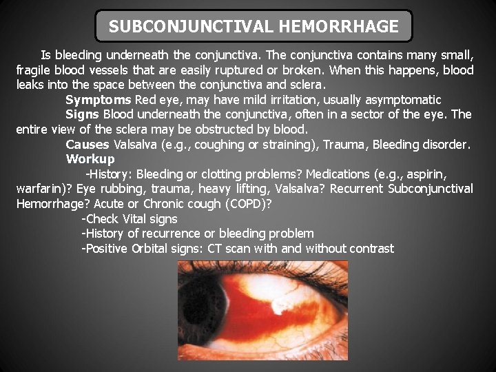 SUBCONJUNCTIVAL HEMORRHAGE Is bleeding underneath the conjunctiva. The conjunctiva contains many small, fragile blood