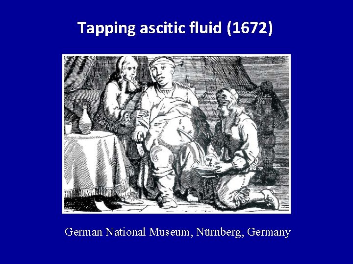 Tapping ascitic fluid (1672) German National Museum, Nürnberg, Germany 