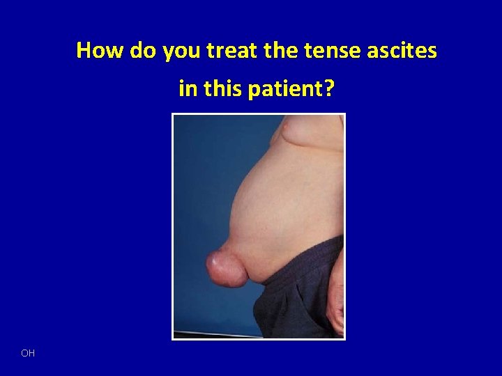 How do you treat the tense ascites in this patient? OH 