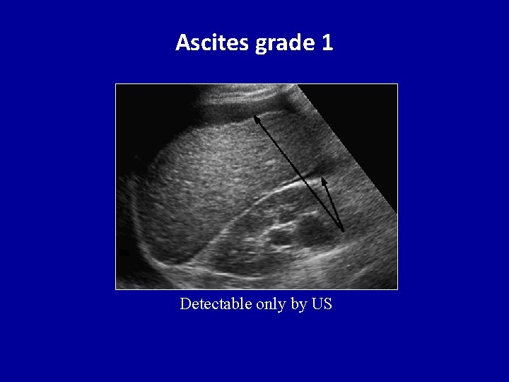 Ascites grade 1 Detectable only by US 