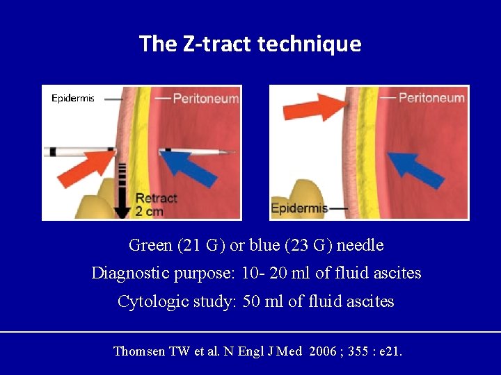 The Z-tract technique Green (21 G) or blue (23 G) needle Diagnostic purpose: 10