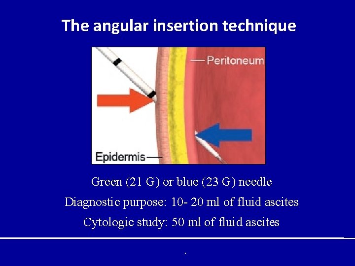 The angular insertion technique Green (21 G) or blue (23 G) needle Diagnostic purpose: