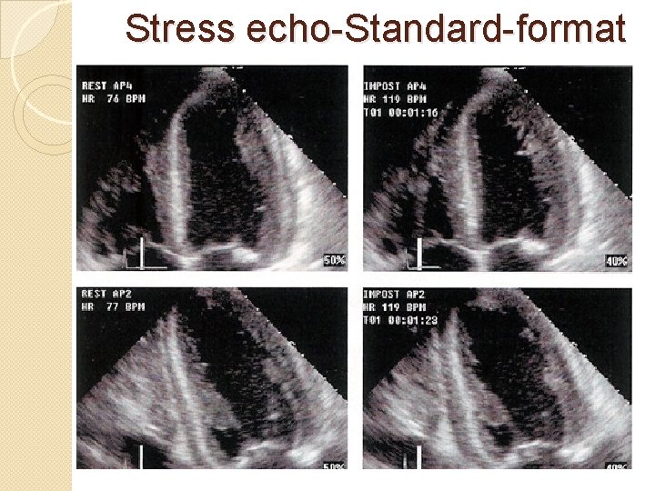 Stress echo-Standard-format 
