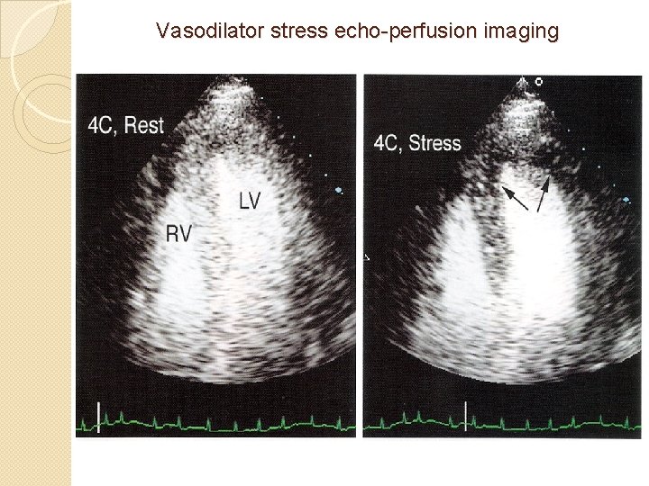 Vasodilator stress echo-perfusion imaging 