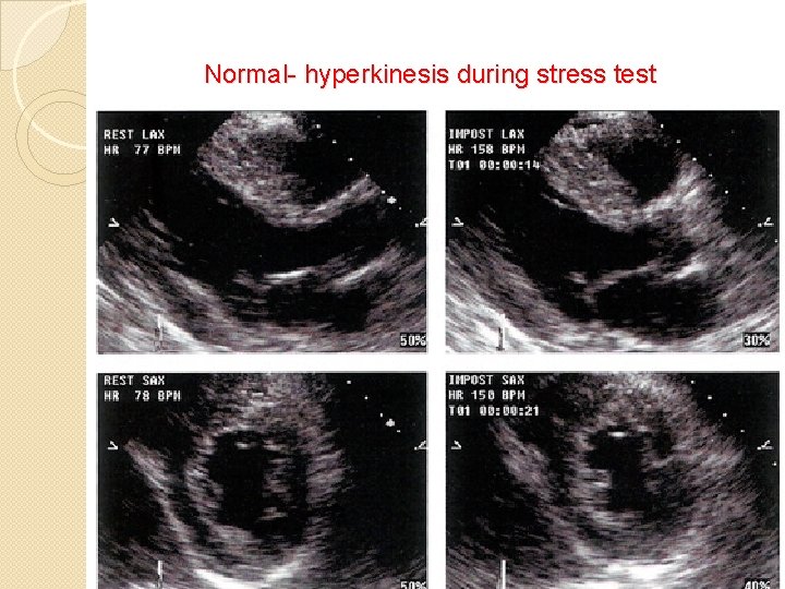 Normal- hyperkinesis during stress test 
