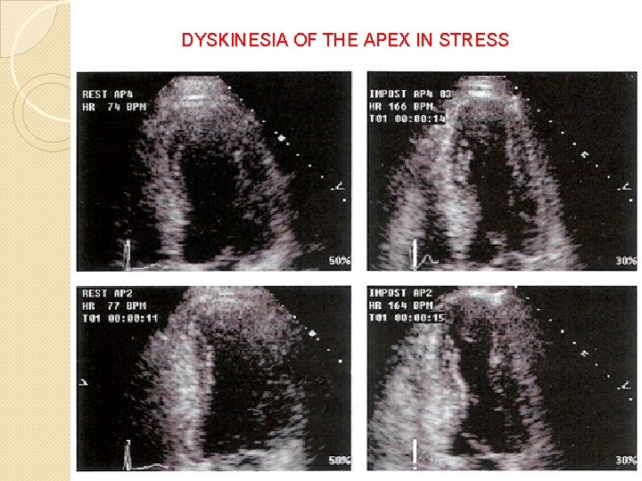 DYSKINESIA OF THE APEX IN STRESS 