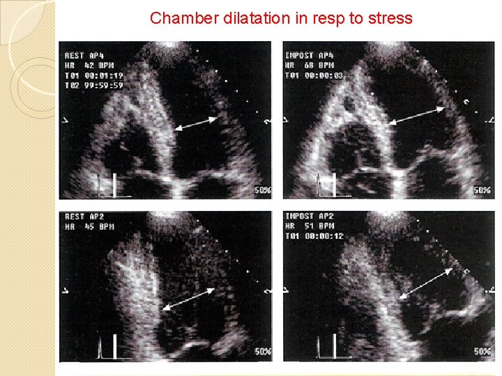 Chamber dilatation in resp to stress 