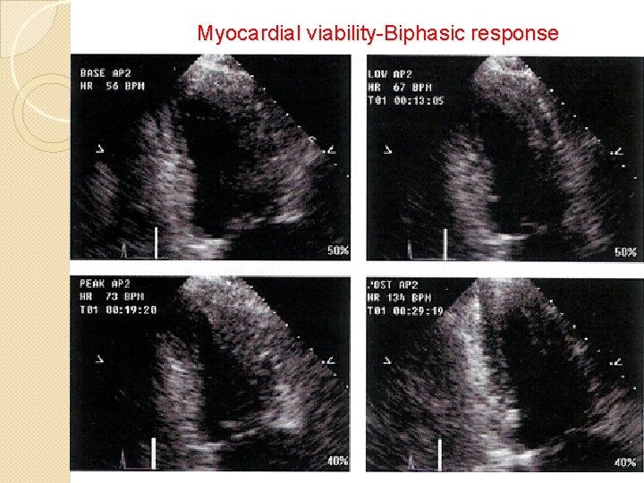 Myocardial viability-Biphasic response 