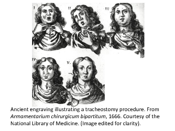 Ancient engraving illustrating a tracheostomy procedure. From Armamentarium chirurgicum bipartitum, 1666. Courtesy of the