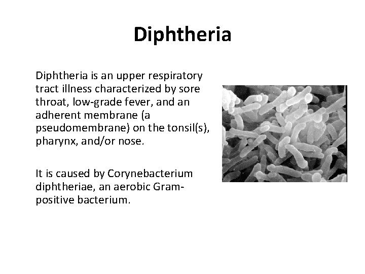 Diphtheria is an upper respiratory tract illness characterized by sore throat, low-grade fever, and