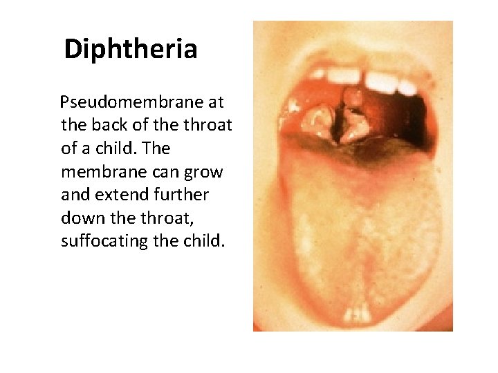 Diphtheria Pseudomembrane at the back of the throat of a child. The membrane can