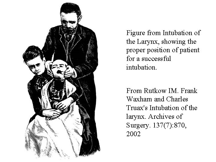 Figure from Intubation of the Larynx, showing the proper position of patient for a