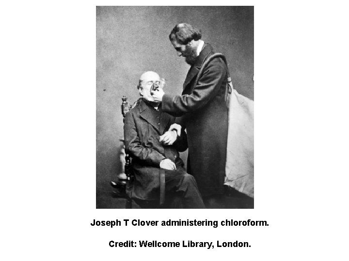 Joseph T Clover administering chloroform. Credit: Wellcome Library, London. 