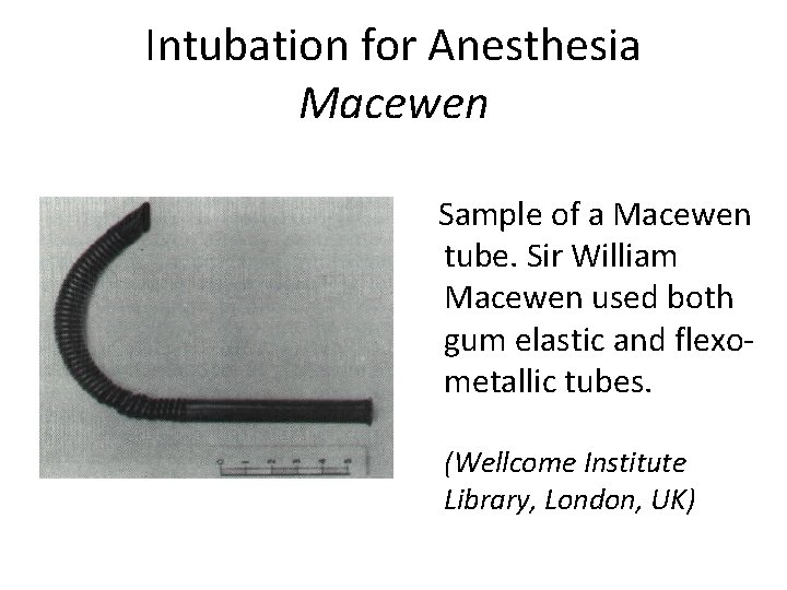 Intubation for Anesthesia Macewen Sample of a Macewen tube. Sir William Macewen used both