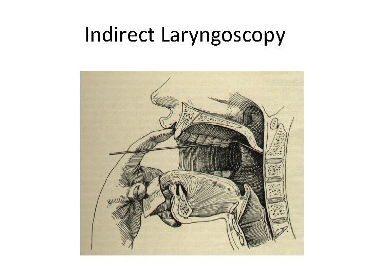 Indirect Laryngoscopy 